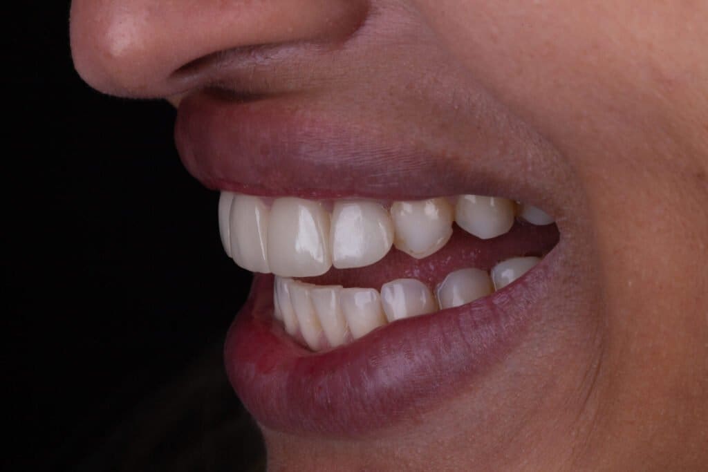 antes lentes catarina