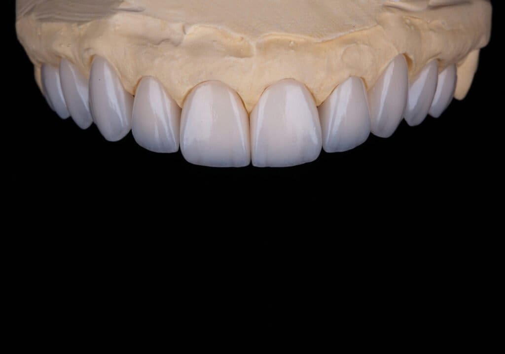 Lente de Contato Dental modelo superior