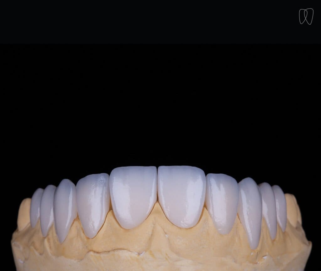 Lente de Contato Dental superior