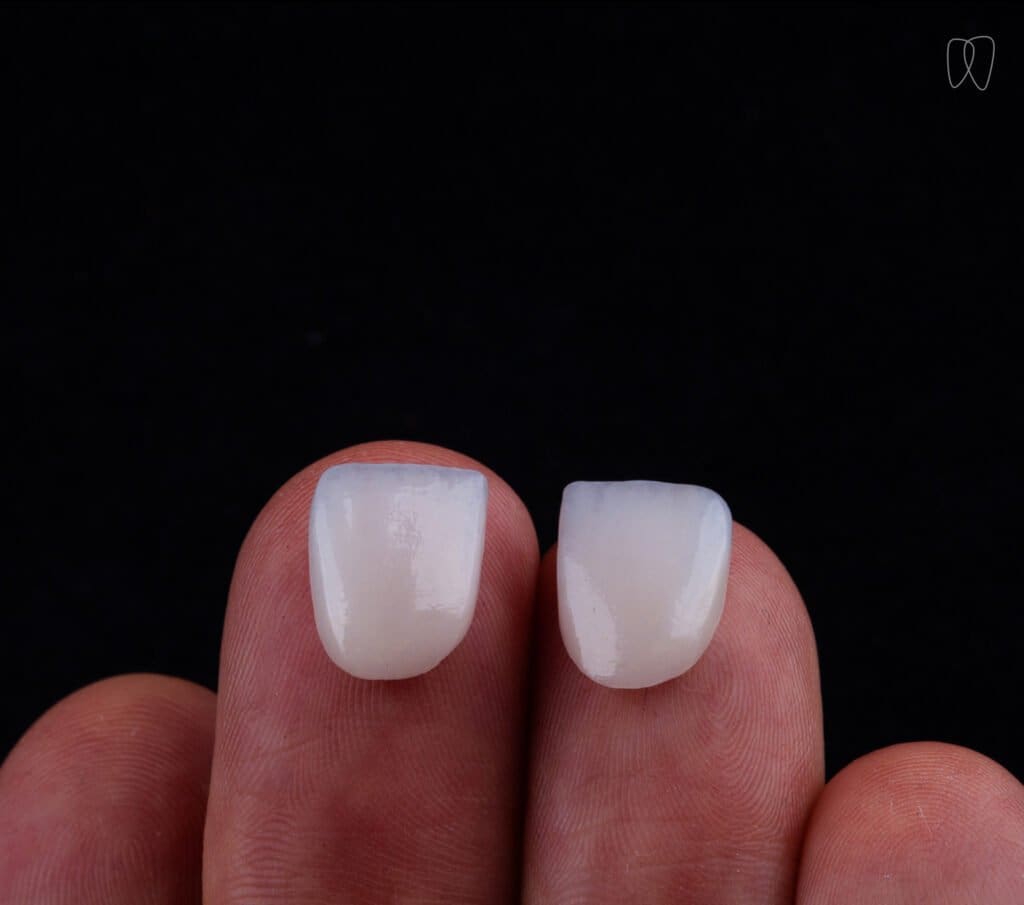 Entenda a diferença entre faceta de porcelana e lente de contato dental