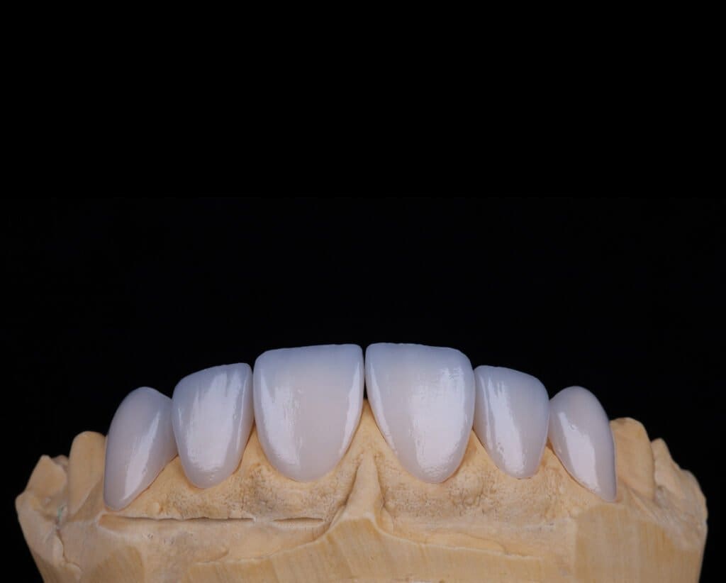 Lente de Contato Dental Modelo
