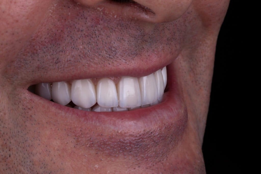 depois Lente de Contato Dental