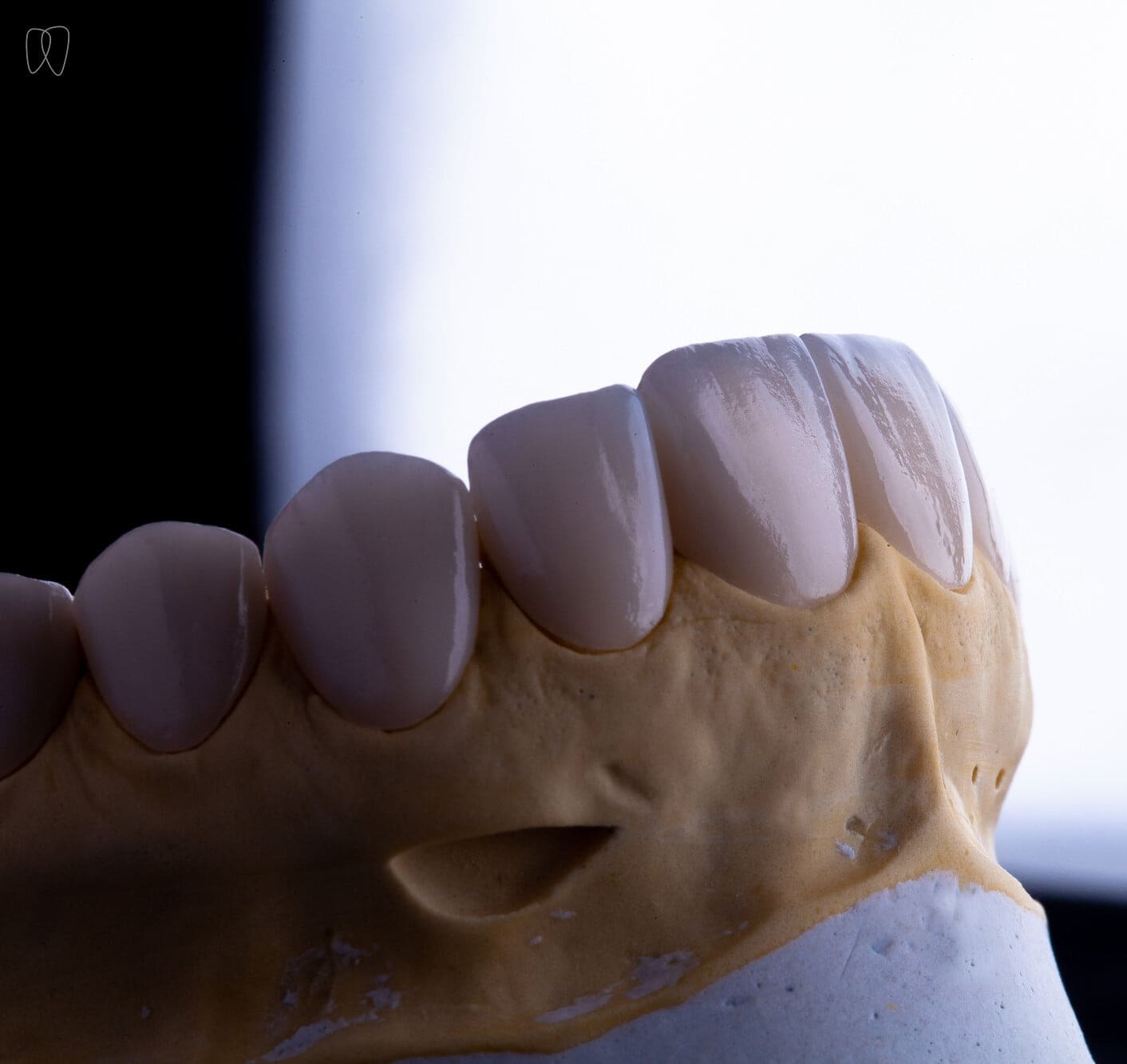 Tratamento de canal x lente de contato dental: quando realmente é necessário?