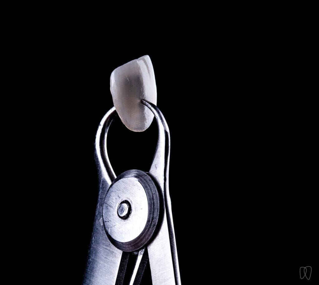 lente de contato dental no espessímetro