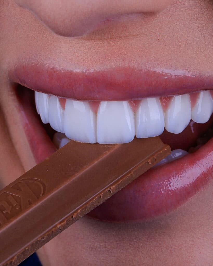 Paciente sorrindo após tratamento com lente de contato dental em porcelana, representando o resultado do Protocolo Borille em Porto Alegre